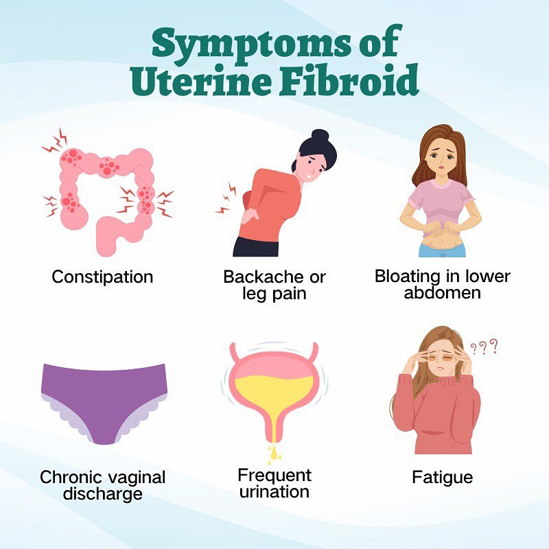 non-invasive fibroid treatment